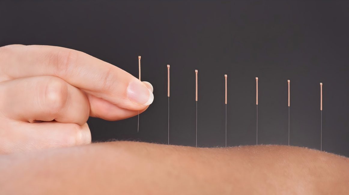 Acupuncture in Traditional Chinese Medicine: A Time-Honored Healing Art